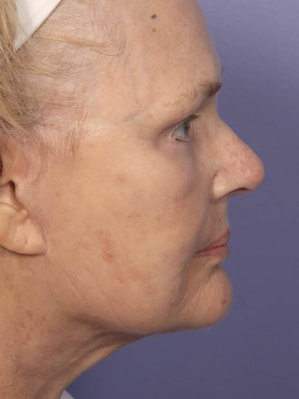 Facelift Before & After Image