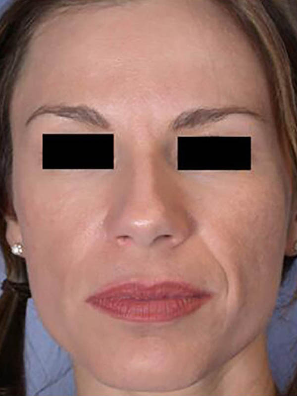 Facelift Before & After Image