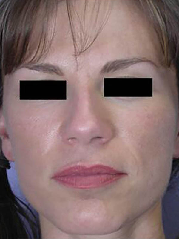 Facelift Before & After Image