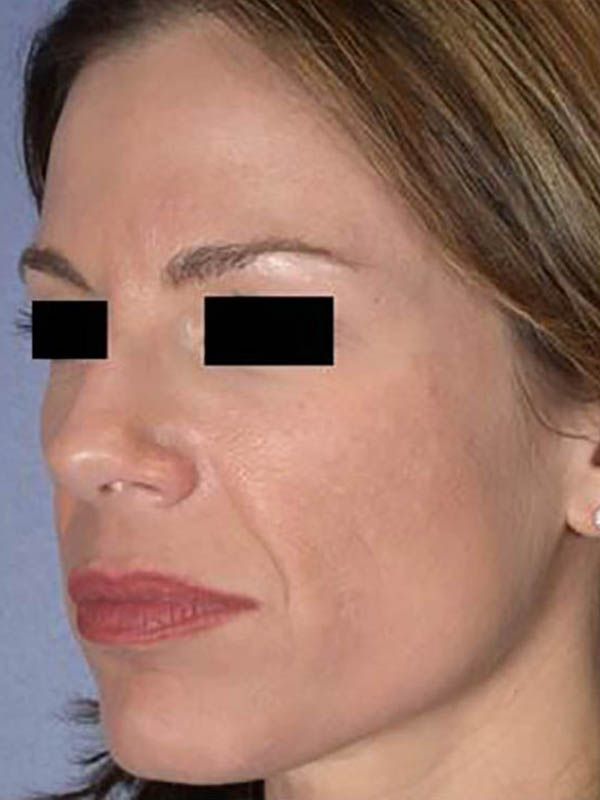 Facelift Before & After Image