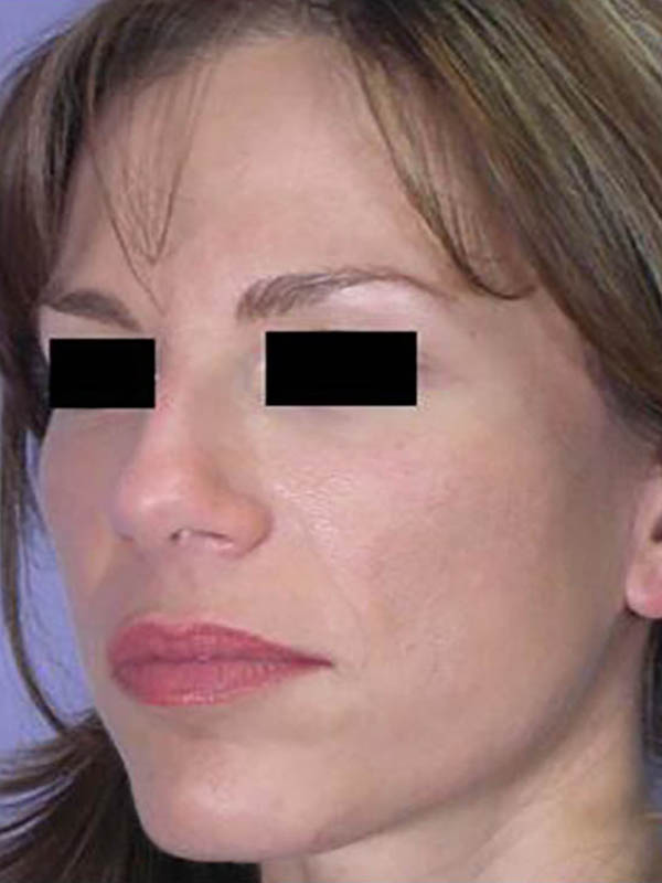 Facelift Before & After Image