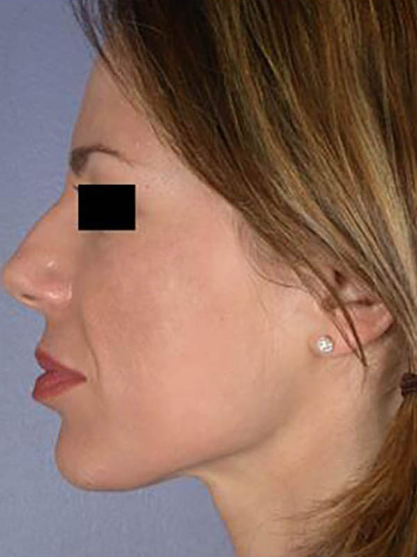 Facelift Before & After Image