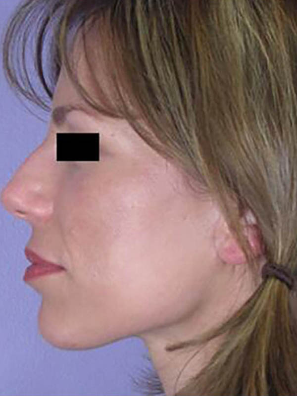 Facelift Before & After Image