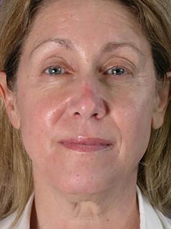 Facelift Before & After Image