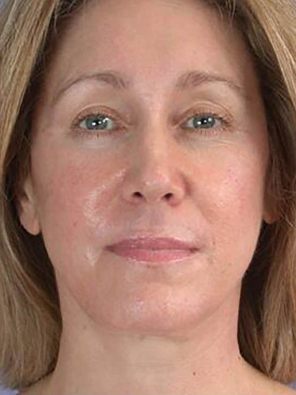 Facelift Before & After Image