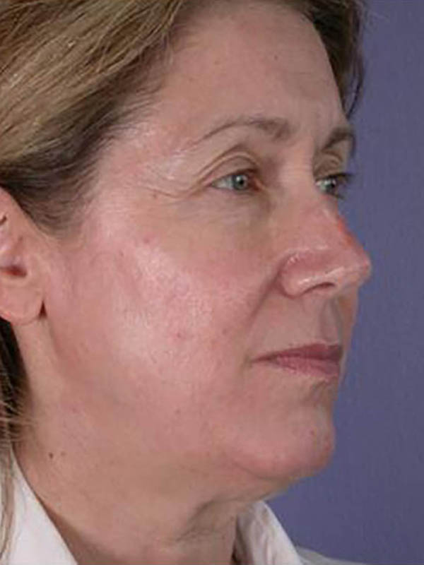 Facelift Before & After Image