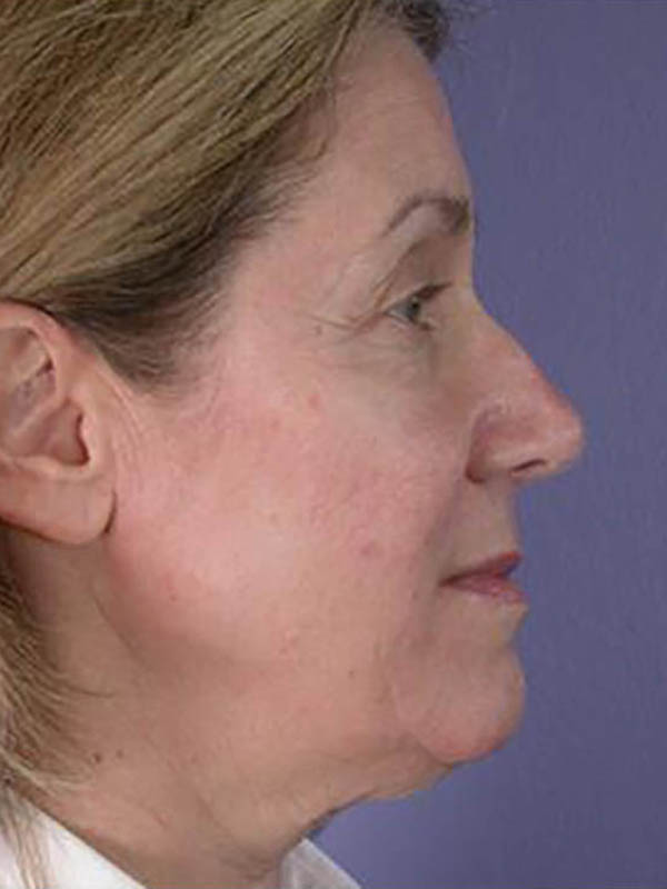 Facelift Before & After Image