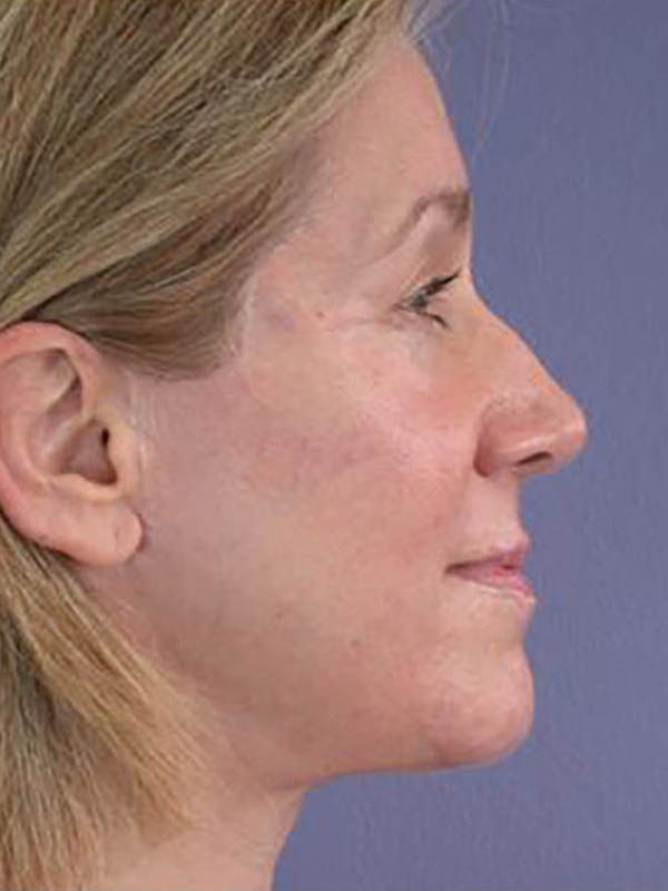 Facelift Before & After Image