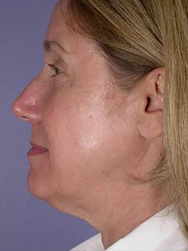 Facelift Before & After Image