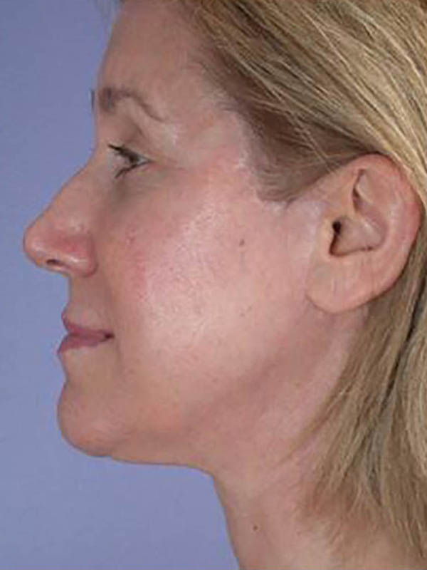 Facelift Before & After Image