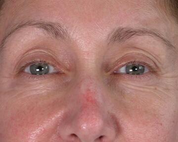 Facelift Before & After Image