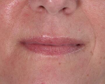 Facelift Before & After Image