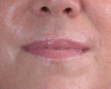 Facelift Before & After Image