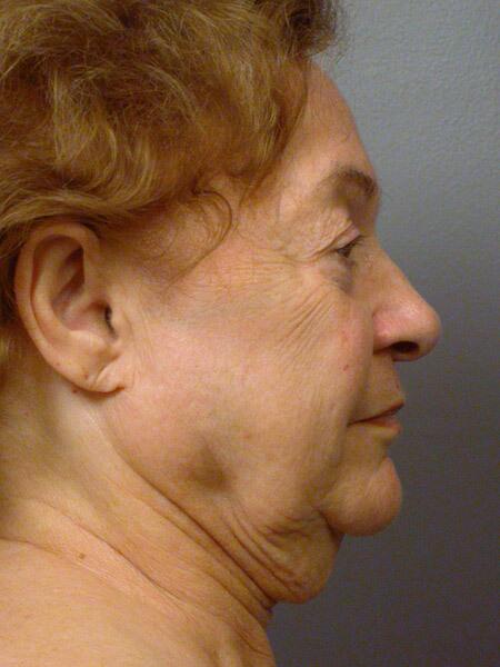 Facelift Before & After Image