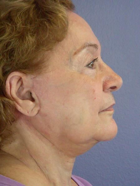 Facelift Before & After Image