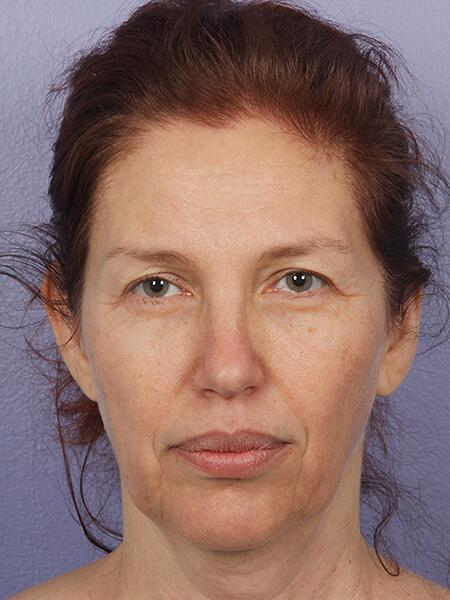 Facelift Before & After Image