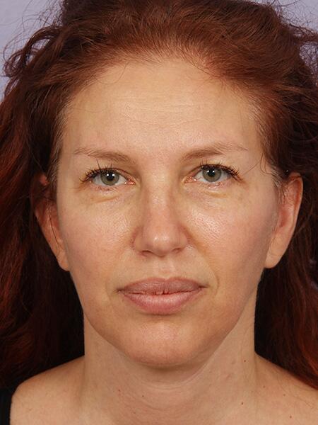 Facelift Before & After Image