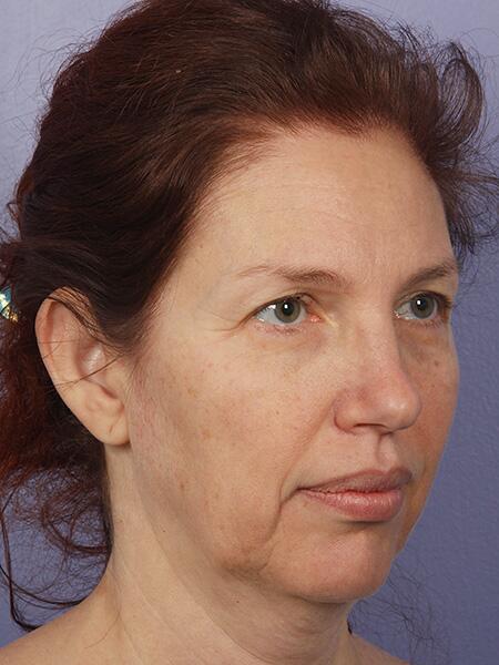 Facelift Before & After Image