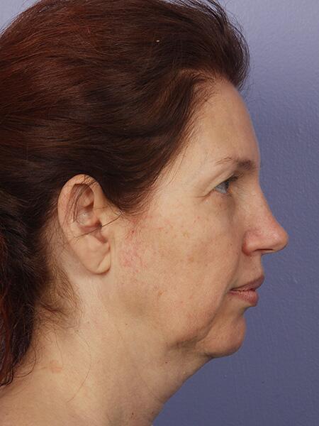 Facelift Before & After Image