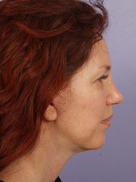 Facelift Before & After Image