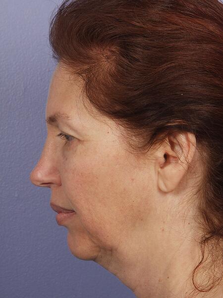 Facelift Before & After Image