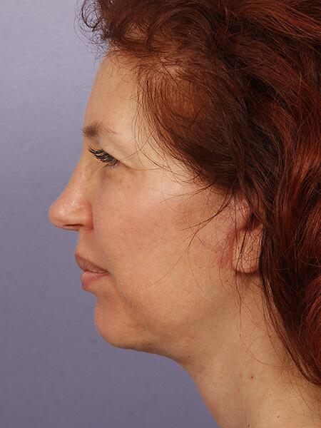 Facelift Before & After Image