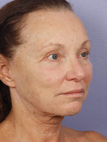 Facelift Before & After Image