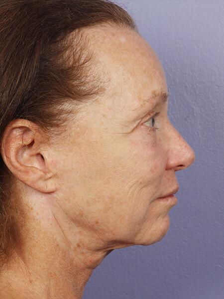 Facelift Before & After Image