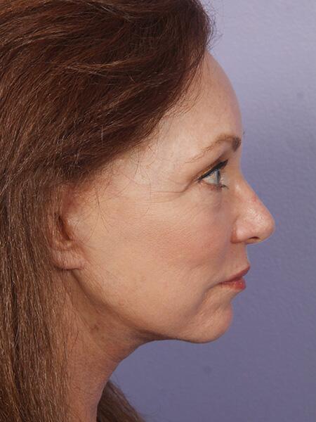 Facelift Before & After Image