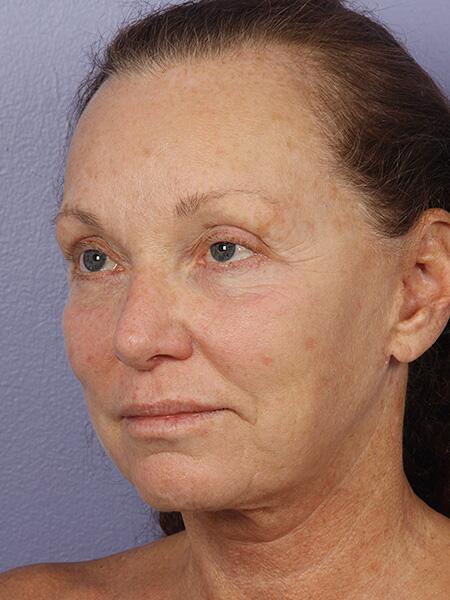 Facelift Before & After Image