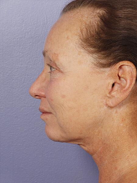 Facelift Before & After Image