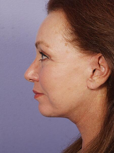 Facelift Before & After Image