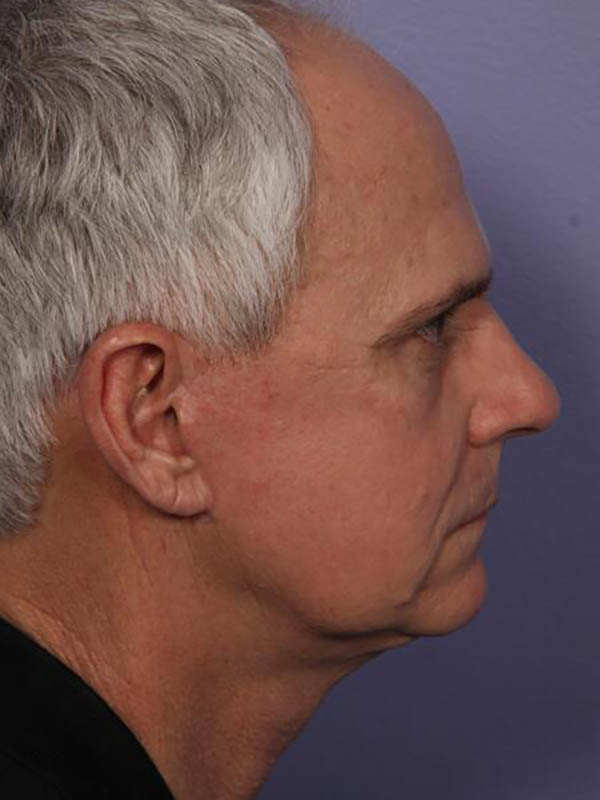 Facelift Before & After Image