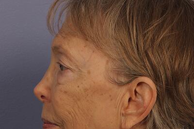 Facelift Before & After Image