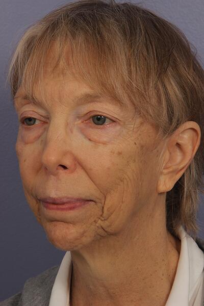 Facelift Before & After Image