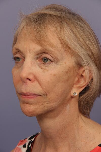 Facelift Before & After Image