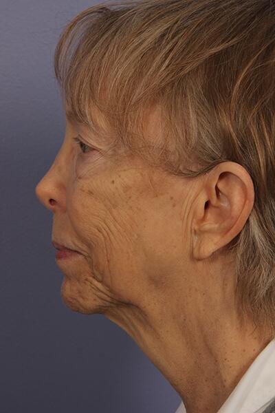 Facelift Before & After Image