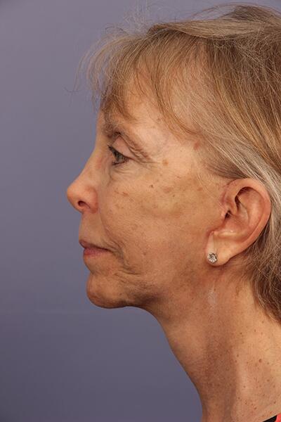 Facelift Before & After Image