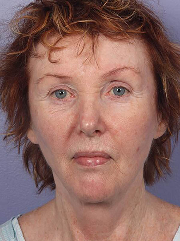 Facelift Before & After Image