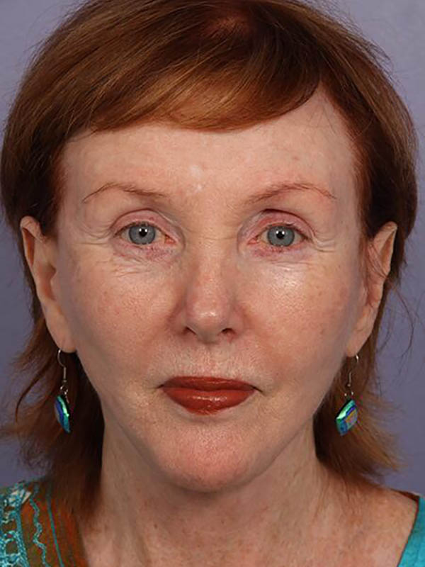 Facelift Before & After Image