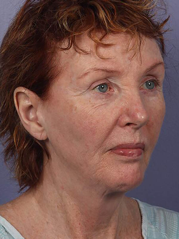 Facelift Before & After Image