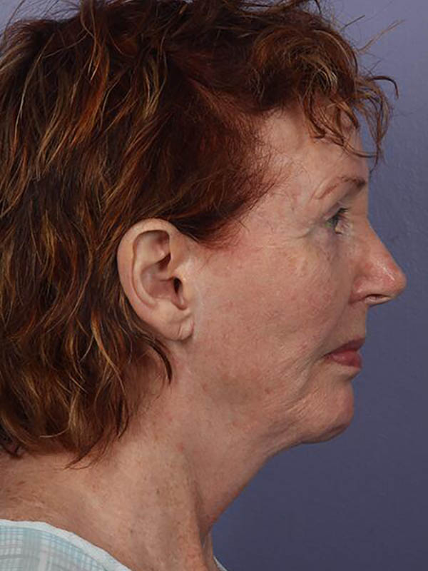 Facelift Before & After Image