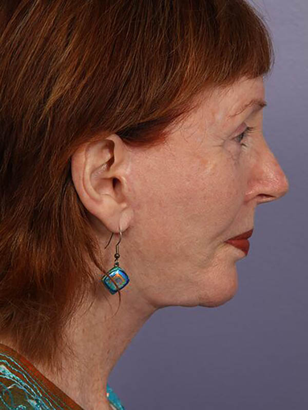 Facelift Before & After Image