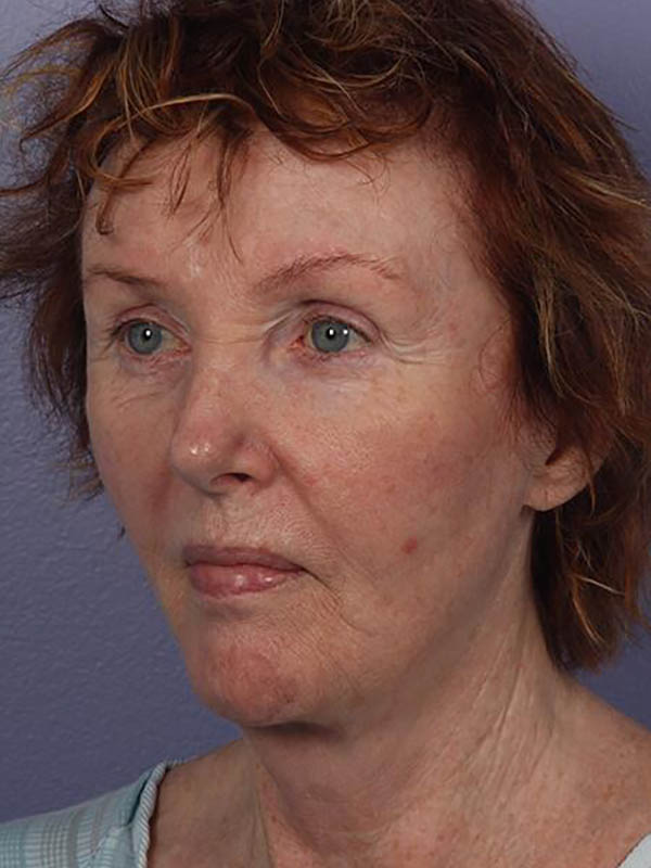 Facelift Before & After Image