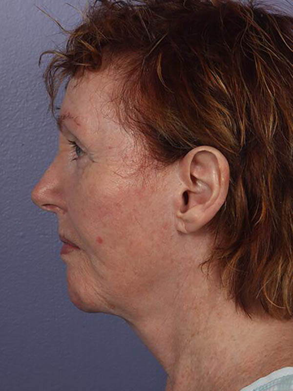 Facelift Before & After Image