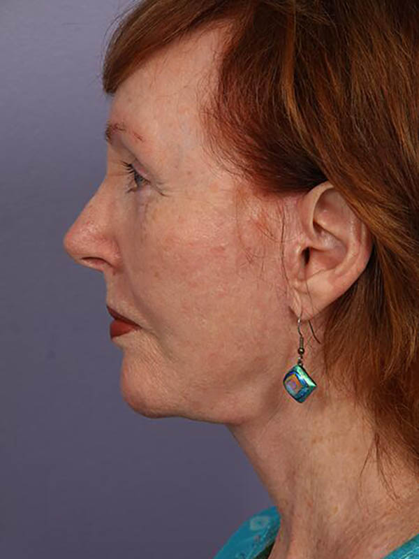 Facelift Before & After Image