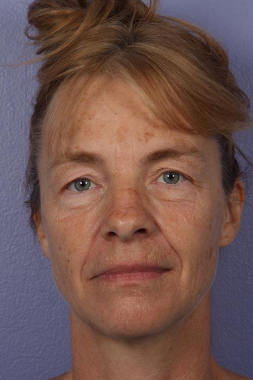 Facelift Before & After Image