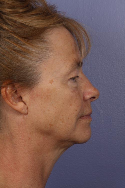 Facelift Before & After Image