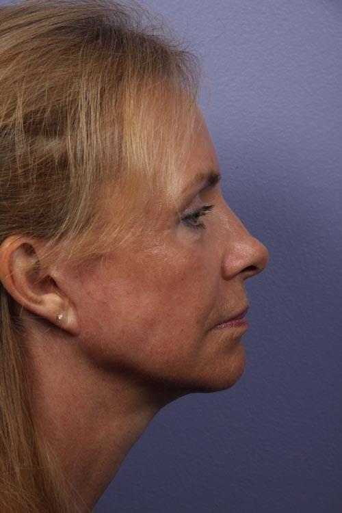 Facelift Before & After Image