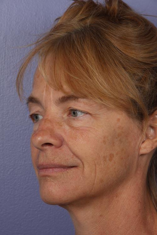 Facelift Before & After Image